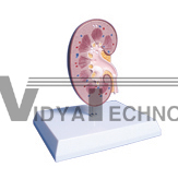 The dissection model of renal calculus